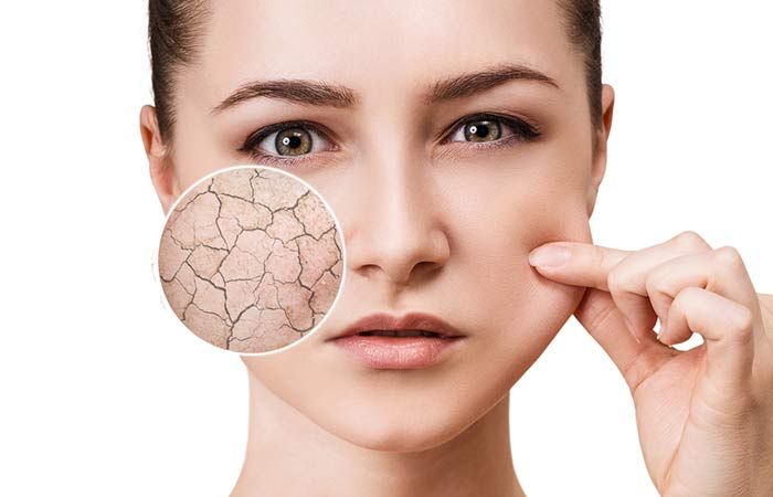 تفاوت پوست دهیدراته با خشک؛ چگونه تشخیص دهیم؟